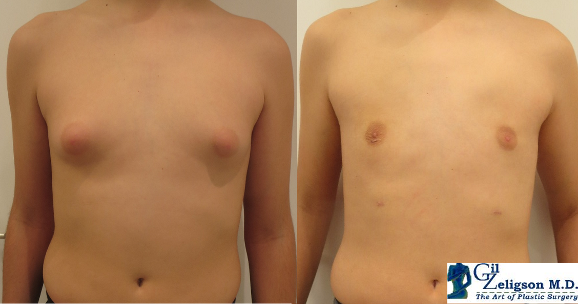 Dr. Gil Zeligson - Gynecomasty