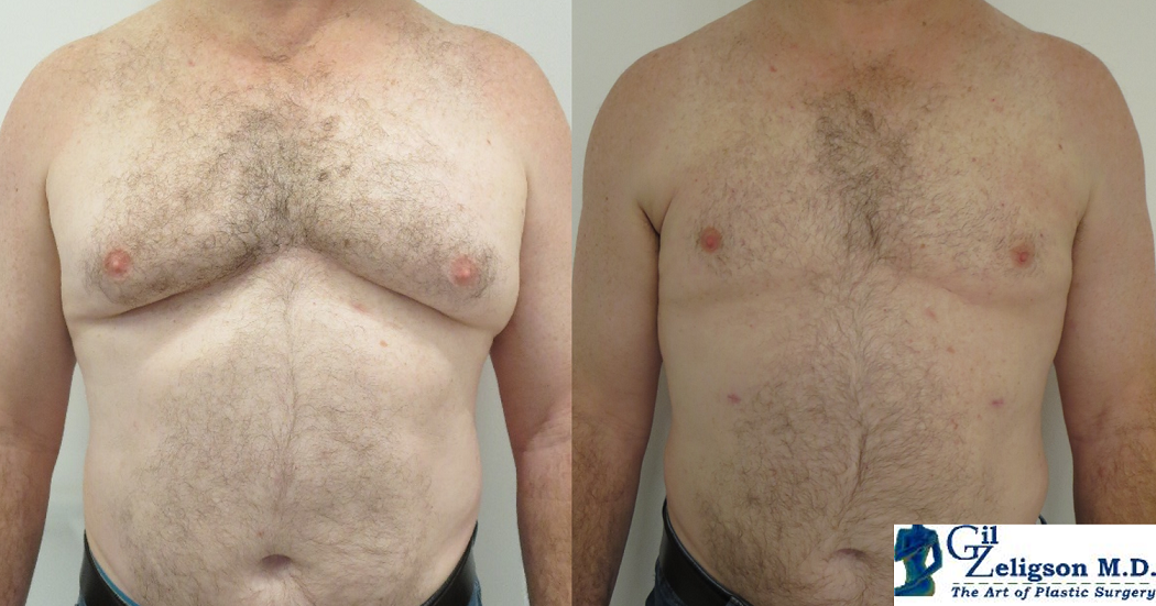 Dr. Gil Zeligson - Gynecomasty