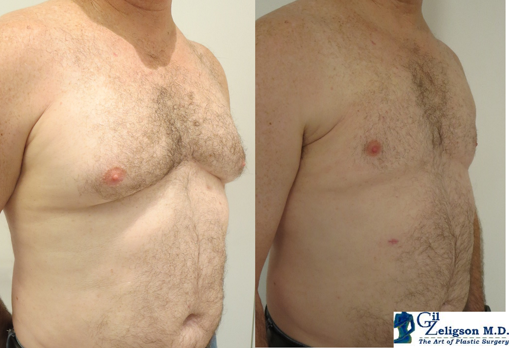 Dr. Gil Zeligson - Gynecomasty