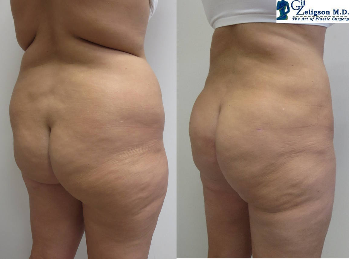 Dr. Gil Zeligson - Liposuction