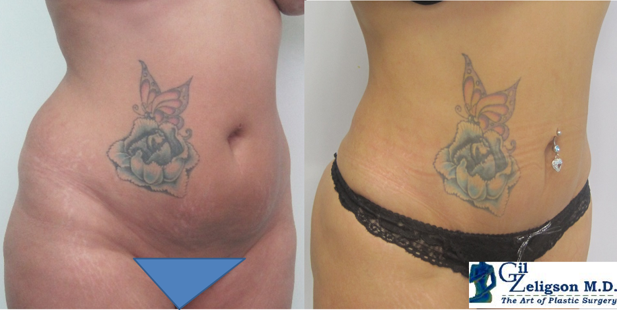 Dr. Gil Zeligson - Liposuction