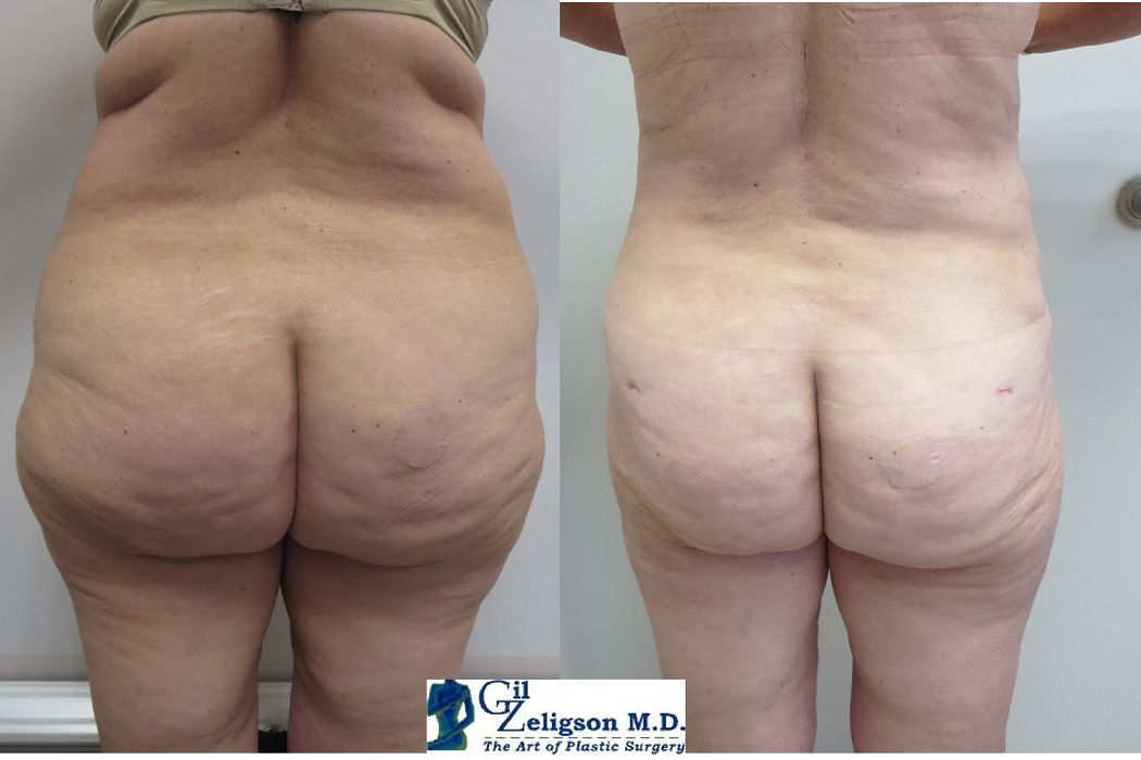 Dr. Gil Zeligson - Liposuction
