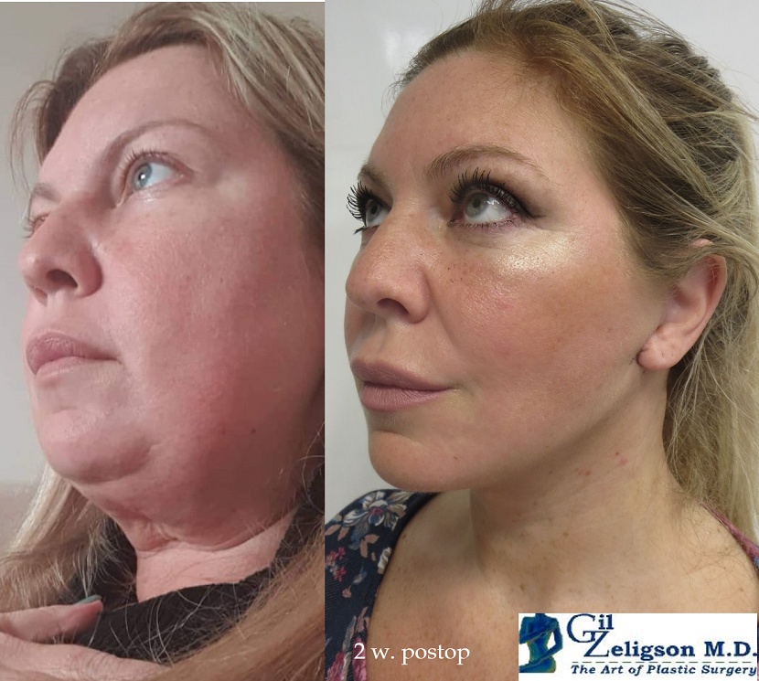 Dr. Gil Zeligson - Facelift