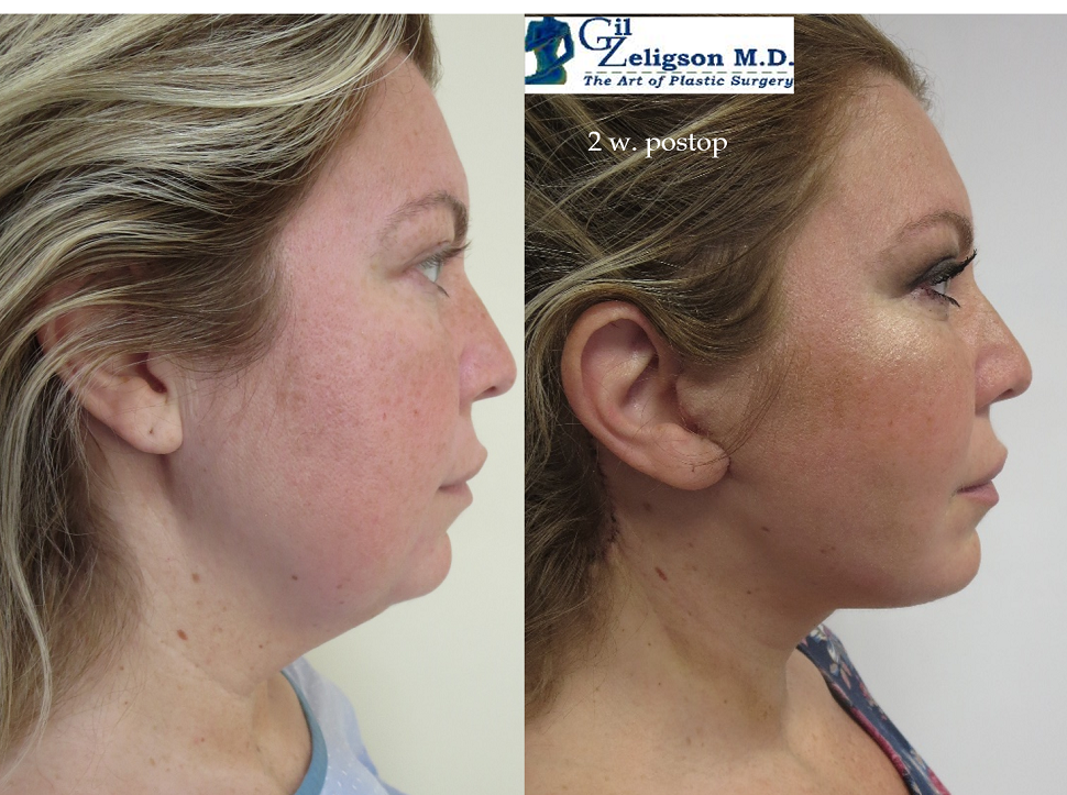 Dr. Gil Zeligson - Facelift