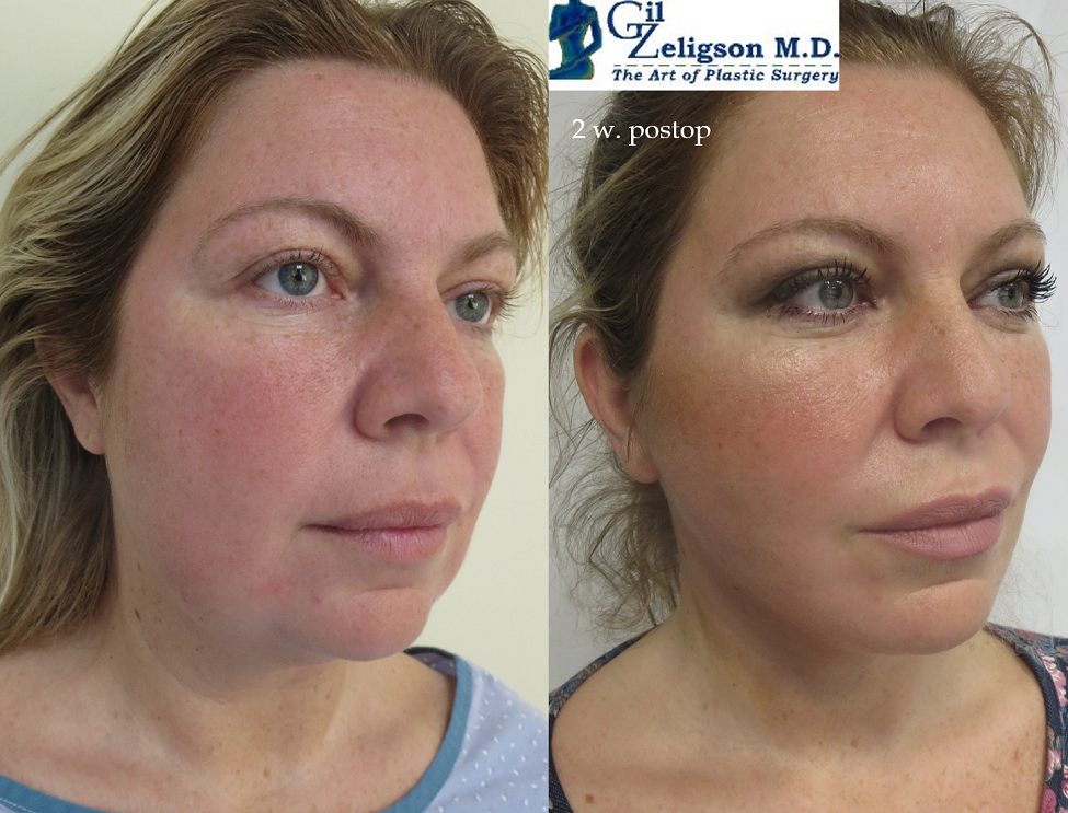 Dr. Gil Zeligson - Facelift