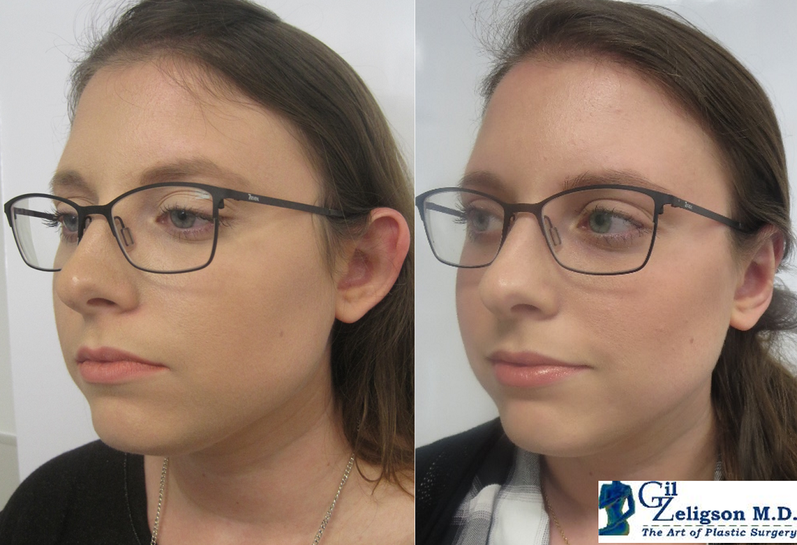 Dr. Gil Zeligson - Otoplasty
