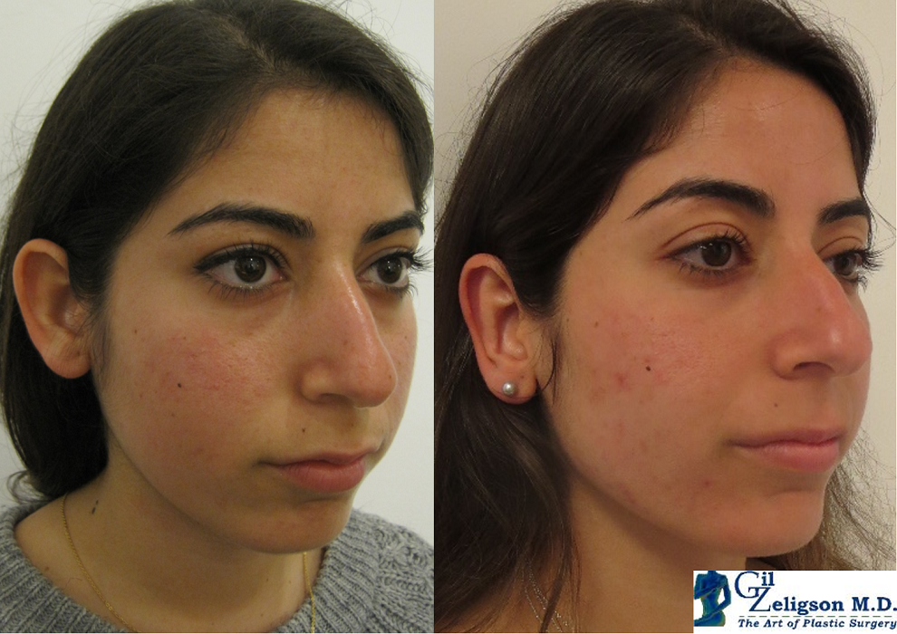Dr. Gil Zeligson - Otoplasty