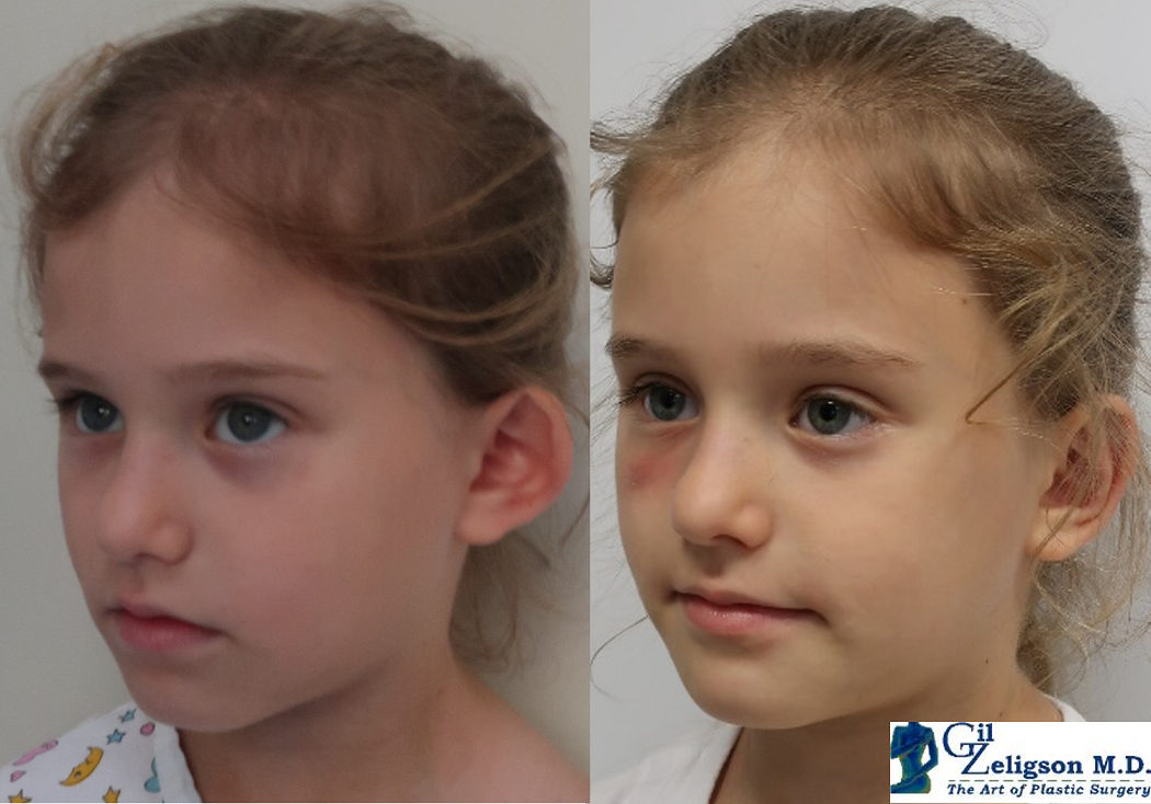 Dr. Gil Zeligson - Otoplasty
