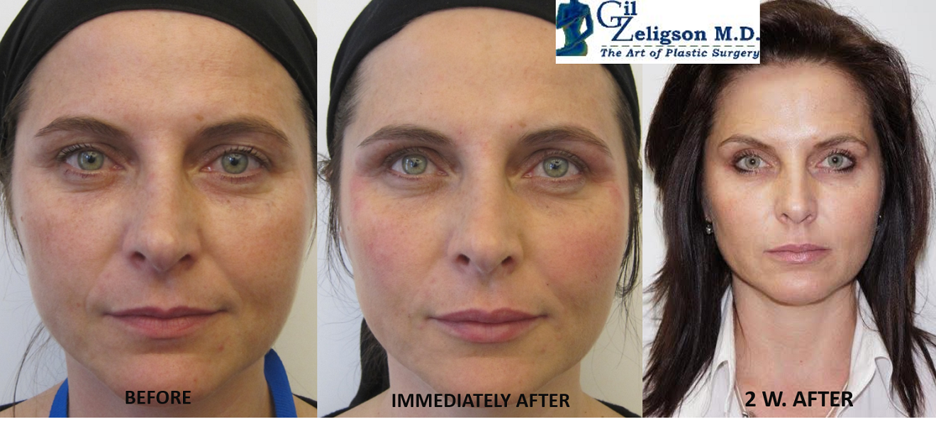 Dr. Gil Zeligson - Facial Sculpturing Hyaluronic acid