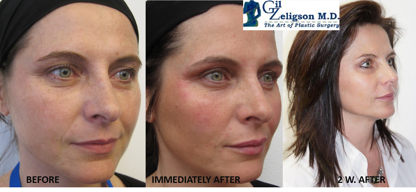 Dr. Gil Zeligson - Facial Sculpturing Hyaluronic acid