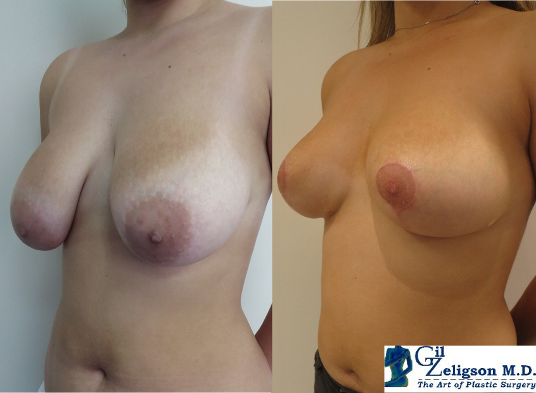 Dr. Gil Zeligson - Breast Reduction