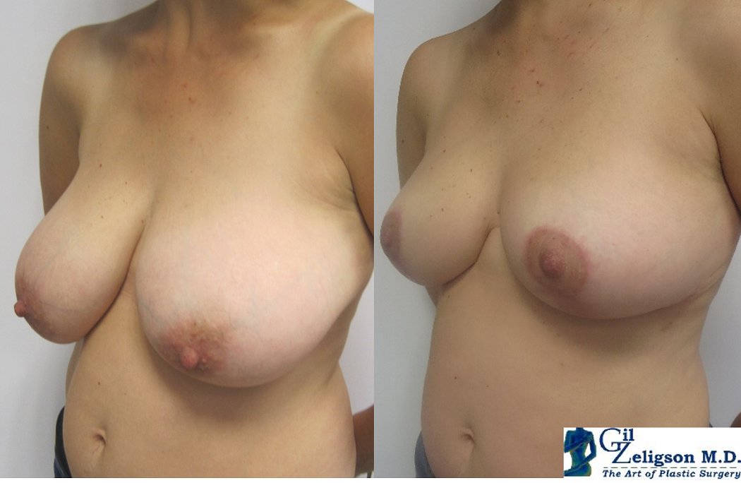 Dr. Gil Zeligson - Breast Reduction