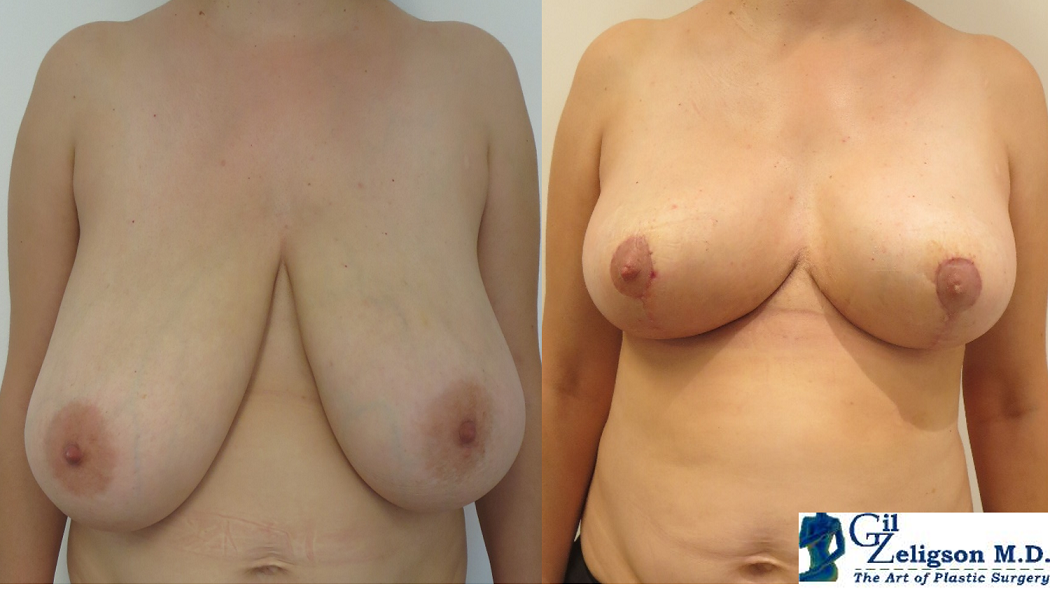 Dr. Gil Zeligson - Breast Reduction