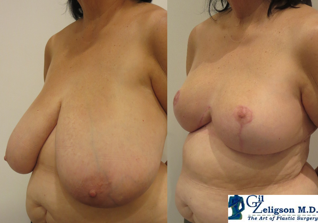 Dr. Gil Zeligson - Breast Reduction