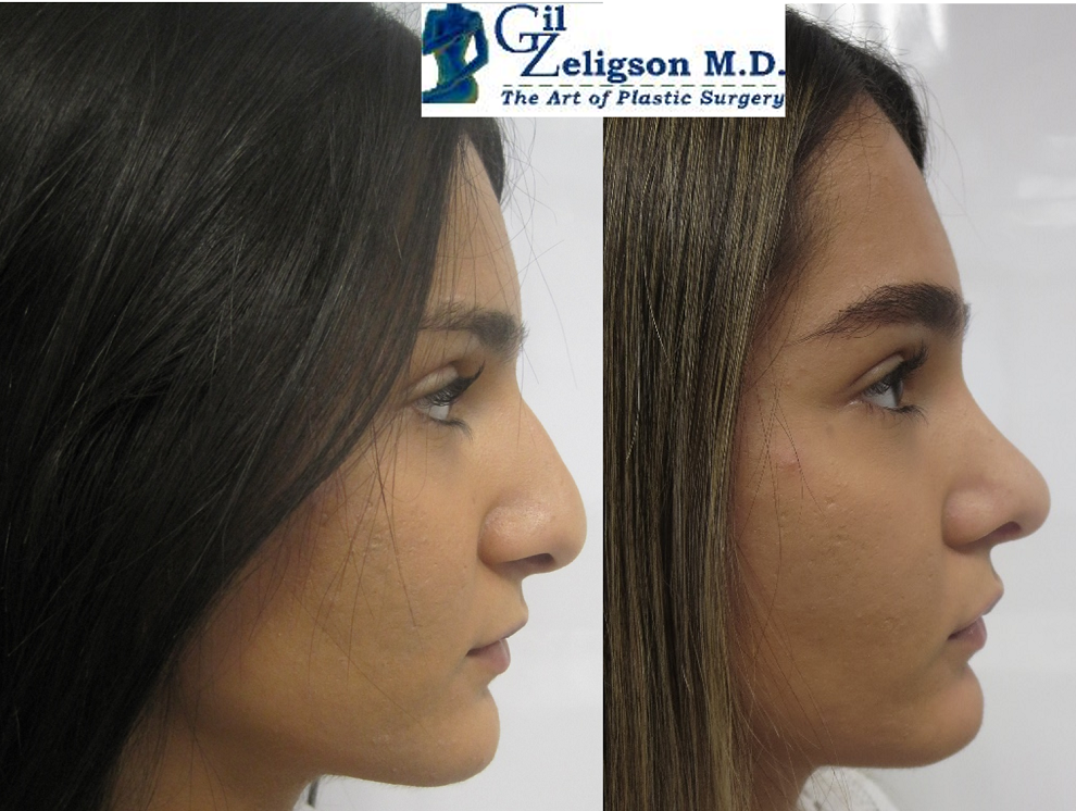 Dr. Gil Zeligson - Rhinoplasty