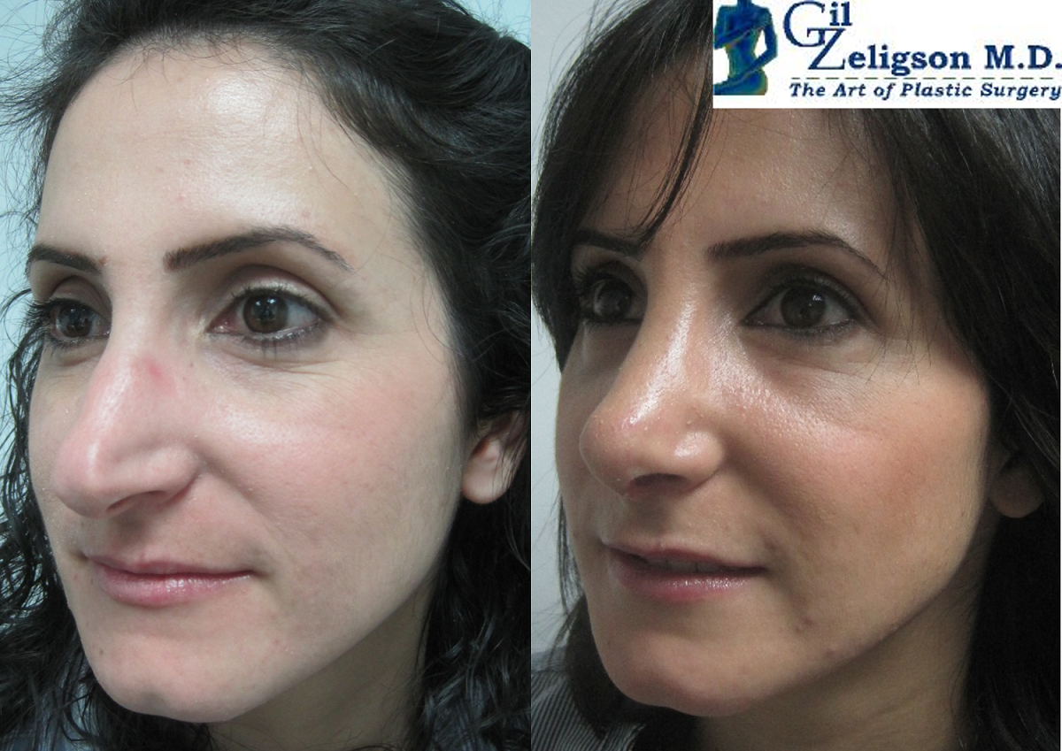 Dr. Gil Zeligson - Rhinoplasty