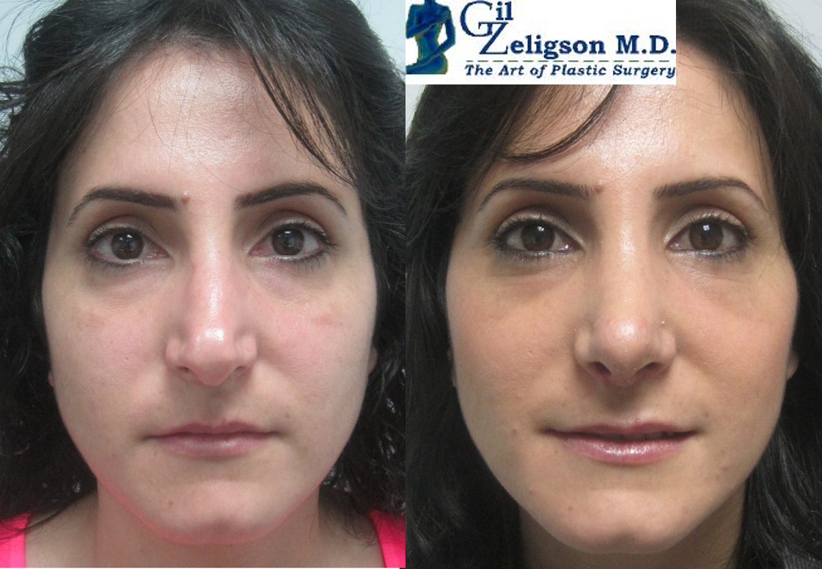 Dr. Gil Zeligson - Rhinoplasty
