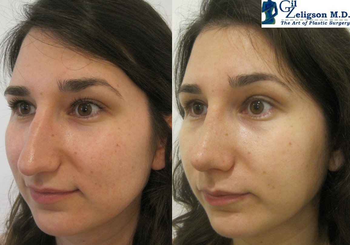 Dr. Gil Zeligson - Rhinoplasty