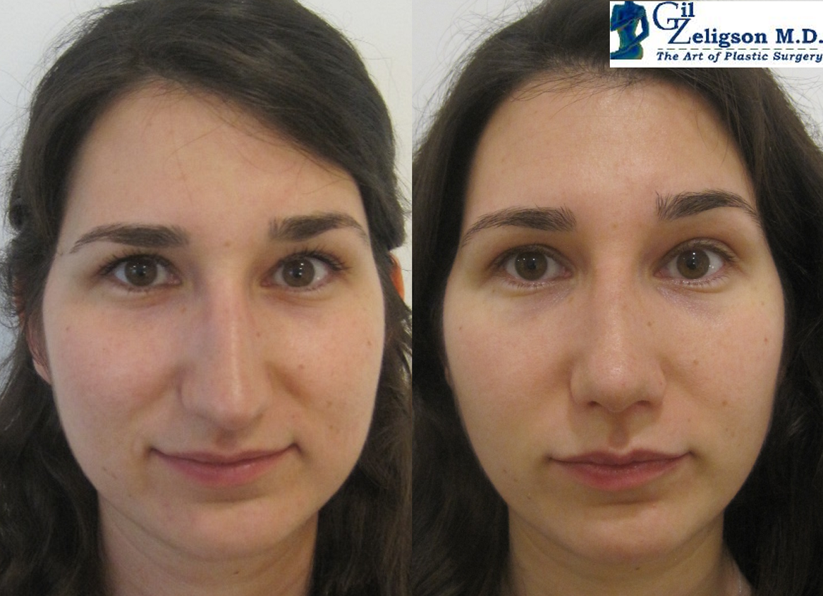 Dr. Gil Zeligson - Rhinoplasty