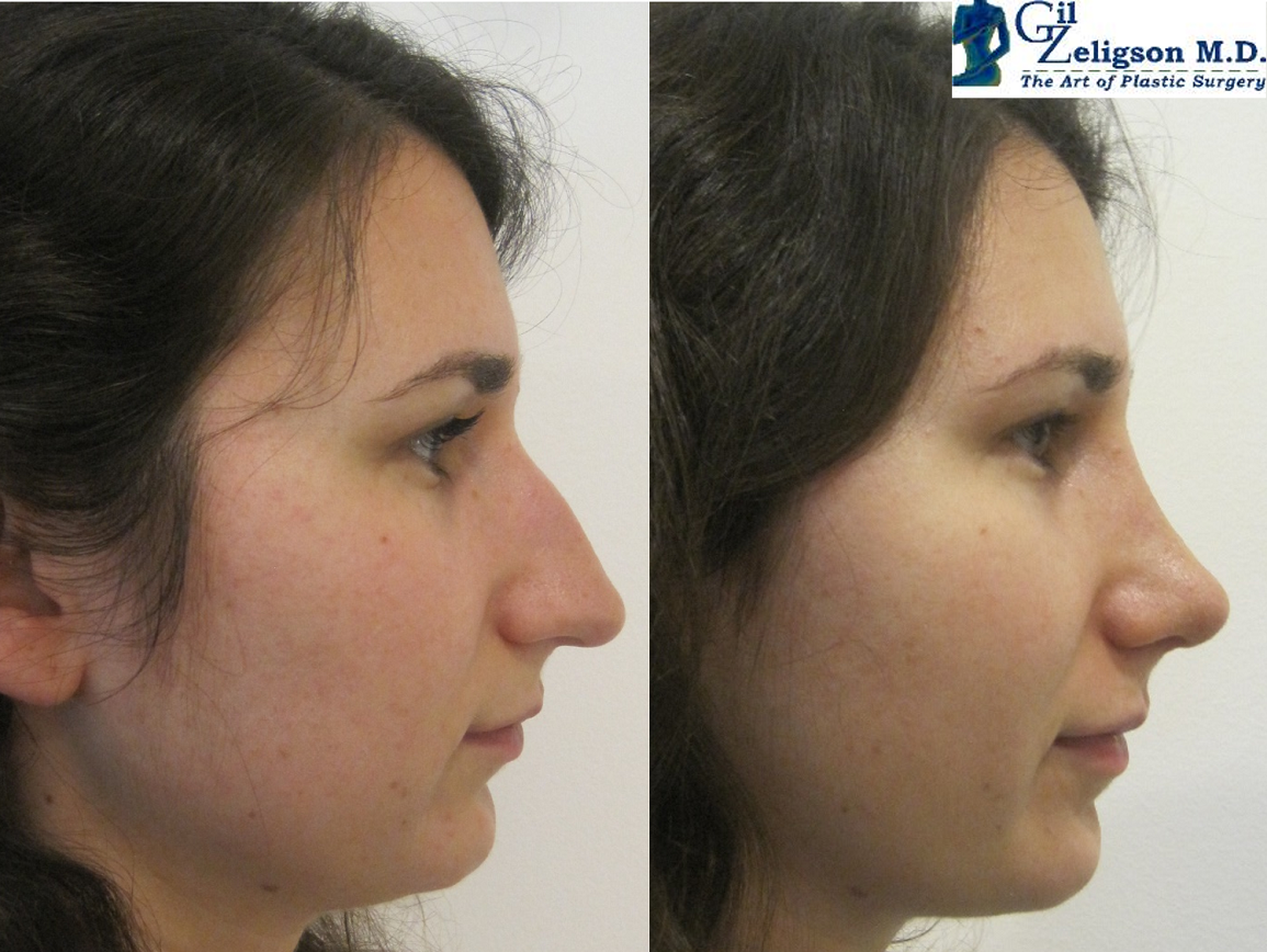 Dr. Gil Zeligson - Rhinoplasty