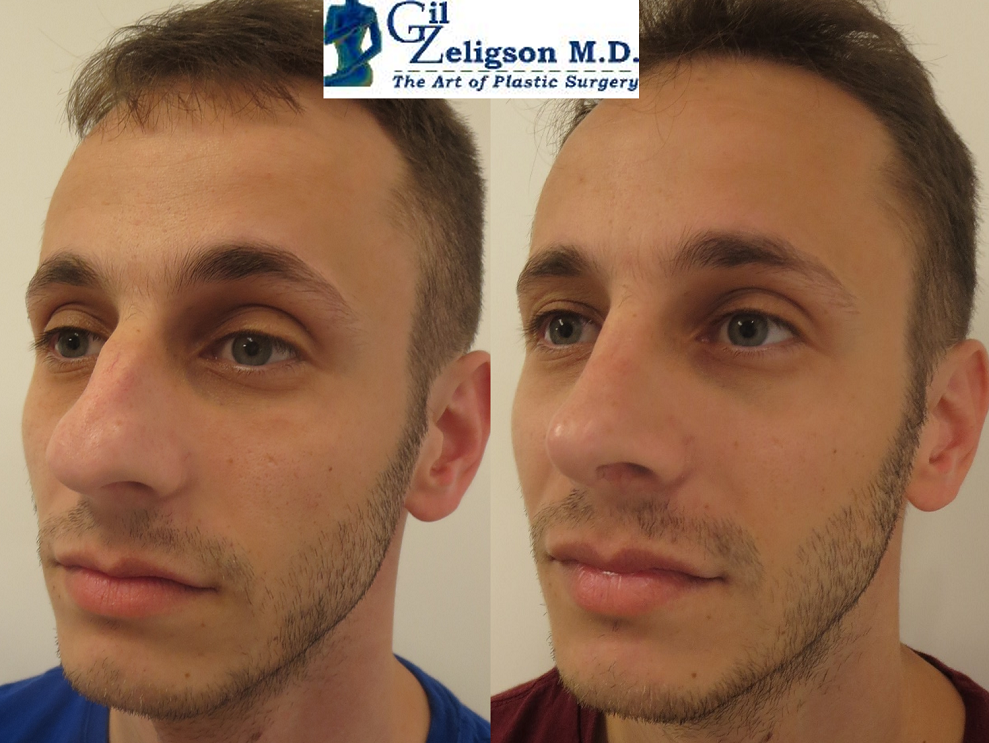 Dr. Gil Zeligson - Rhinoplasty