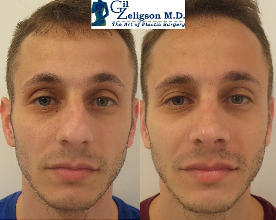 Dr. Gil Zeligson - Rhinoplasty