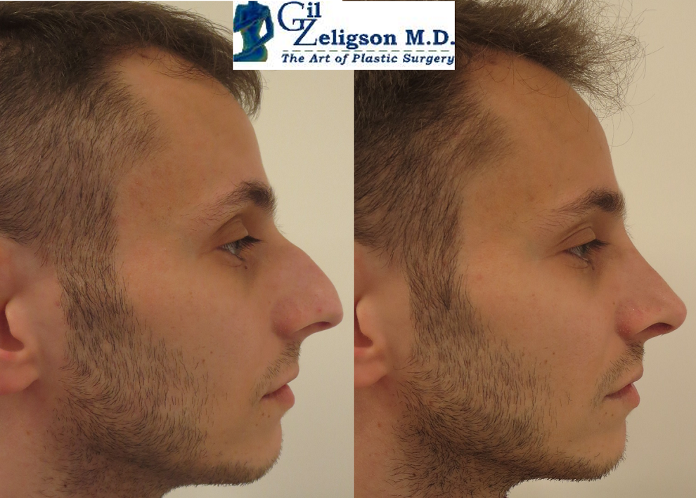 Dr. Gil Zeligson - Rhinoplasty
