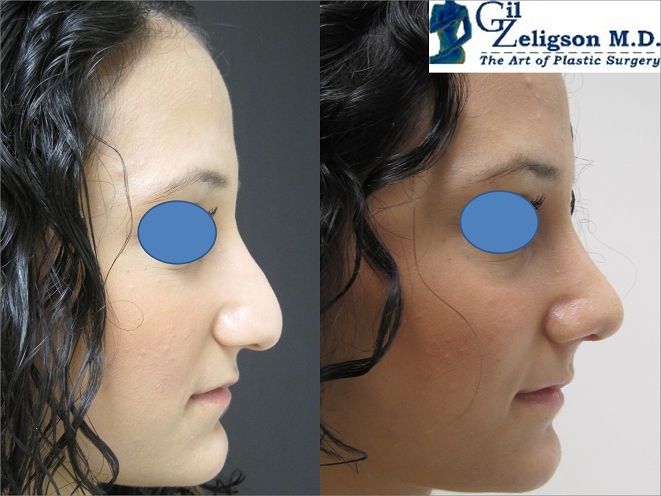 Dr. Gil Zeligson - Rhinoplasty