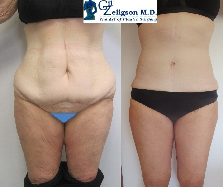 Dr. Gil Zeligson - Tummy Tuck Abdomino plasty
