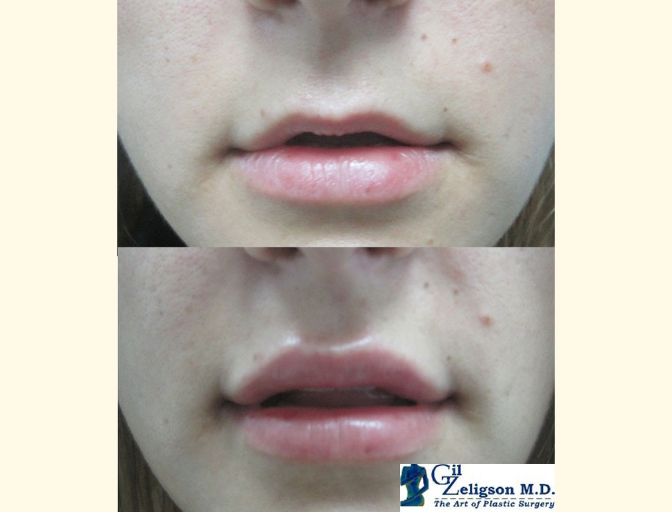 Lips augmentaion & Wrinkles filling