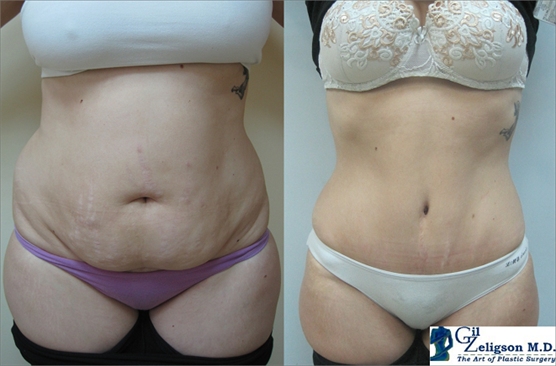 Tummy Tuck Abdomino plasty