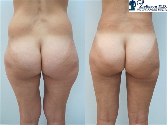 Liposuction